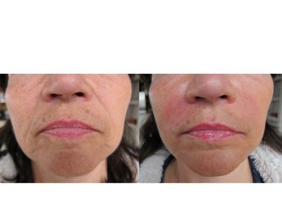 Juvederm before and after photo