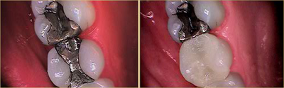 Tooth Repair before and after photo