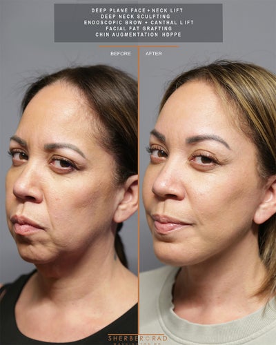 Facelift before and after photo