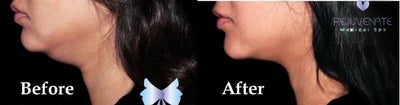 Kybella before and after photo