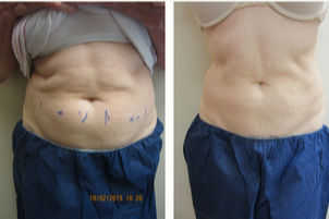 CoolSculpting before and after photo