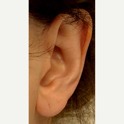 Earlobe Repair In Delhi, Earlobe Repair Cost, Find Best Reviewed Hospitals  & Surgeons, Reviews