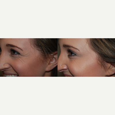 Botox before and after photo