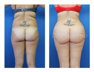 Brazilian Butt Lift before and after photo
