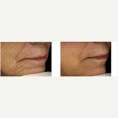 Fraxel Laser before and after photo