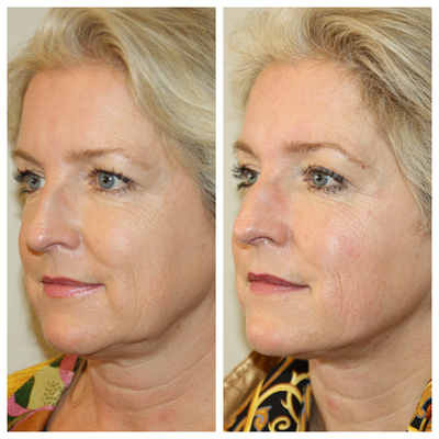 Kybella before and after photo
