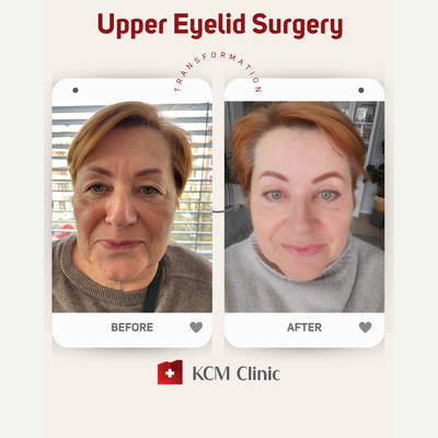 Eyelid Surgery before and after photo