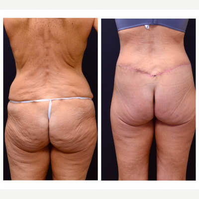 Liposuction before and after photo