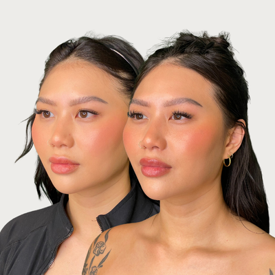 Chin Filler before and after photo