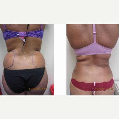 Laser Liposuction before and after photo