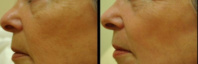 CO2 Laser before and after photo