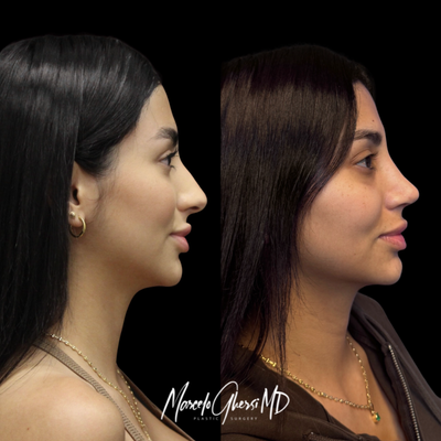 Rhinoplasty before and after photo