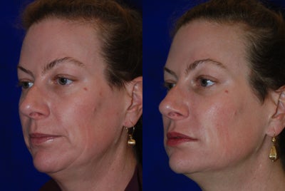 Liquid Facelift before and after photo
