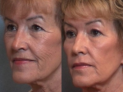 Laser Resurfacing before and after photo