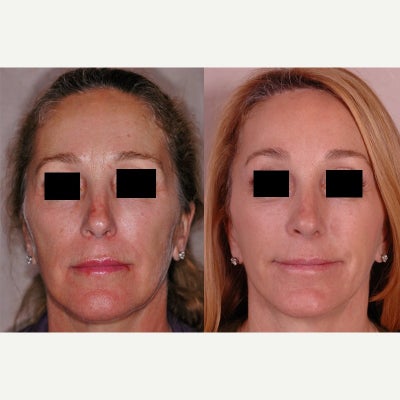 Brow Lift before and after photo