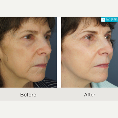 Mini Facelift before and after photo