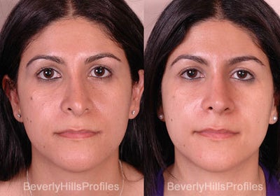 Revision Rhinoplasty before and after photo