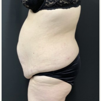 TUMMY TUCK ON A PLUS SIZE PATIENT IN GILBERT, AZ - Patient Galleries  Archive - Jude LaBarbera MD Plastic Surgery