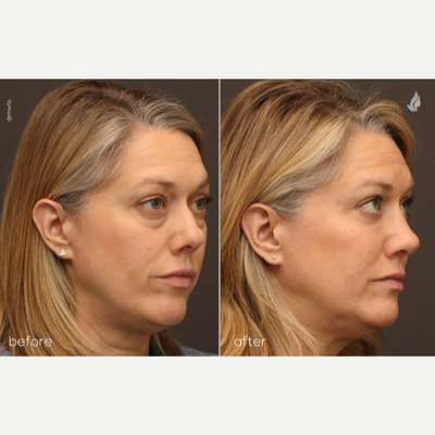 Eyelid Surgery before and after photo
