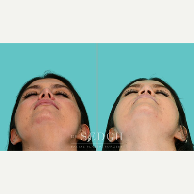 Revision Rhinoplasty before and after photo