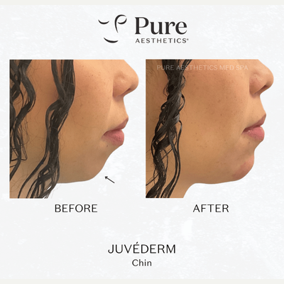 Juvederm before and after photo