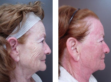 CO2 Laser before and after photo