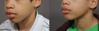 Lip Reduction before and after photo