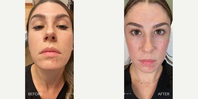 ACNE SCAR COMBO - Our patient works in the industry, so she wants her skin to look its absolute best, which means being free of her troublesome acne scars. She has been following our work for 3 years and is excited to finally get the results she has been dreaming of. By combining several amazing treatments like Bellafill and our lasers with our latest treatment Glacial, we were able to get her some of the best results we have ever seen after just one treatment. GLACIAL FACIALOne of the most pleasant elements to our patient's treatment and recovery was her Glacial facial. Combined with the Emer Skin Intense Hydration Mask, we were able to utilize the Glacial technology to its greatest potential to provide excellent cooling and anti-inflammatory treatment to her. She loved how refreshing and soothing the experience was.No treatment is complete without EMER SKIN. Using our products post-treatment will enhance results to the absolute maximum. Click Link in Bio Click Emer Skin