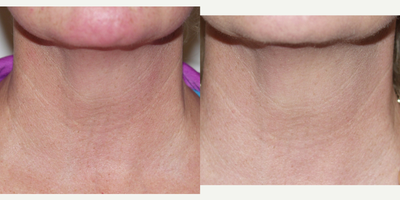 Micro-Botox for neck rejuvenation - Micro-Botox or minute amounts of Botox selectively placed in the neck skin, of this 52 year, has smoothed, tightened and rejuvenated her neck.