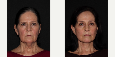 65-74 year old woman treated with Facelift, Brow Lift, Eyelid Surgery, Lip Lift, Facial Fat Transfer - MD Restore, Deep-Plane (Additional Procedures: Brow Lift, Eyelids, Lip Lift, Fat Transfer)