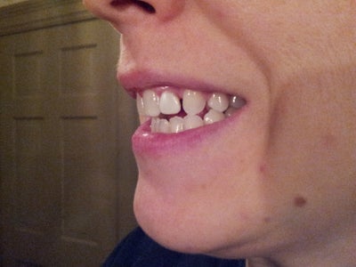 Can I fix this gap without braces? (photo) Dentist Answers ...