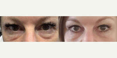 45-54 year old woman treated with Microneedling - Procedure: Agnes RFGender: FemaleEthnicity: CaucasianAge: 41 - 50