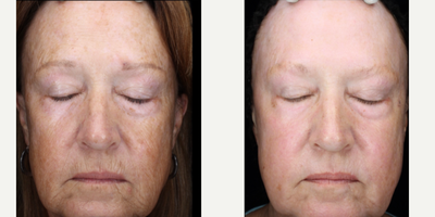 65-74 year old woman treated with Scar Removal, Laser Scar Removal - Full face laser resurfacing