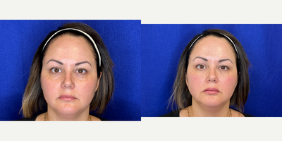 35-44 year old woman treated with RHA Collection Fillers - Lip and Under Eye Hallow/Cheek Bone filler