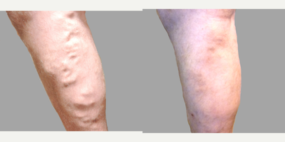 45-54 year old man treated with VenaSeal - Chronic Venous Insufficiency (CVI) Treatment