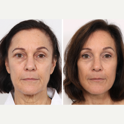 55-64 year old woman treated with Eyelid Surgery, Ptosis Surgery, Brow Lift - My lovely patient is thrilled after her Left Ptosis Repair, Upper Bleph & Brow lift