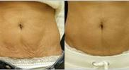 Skintyte - Woman treated with Skintyte