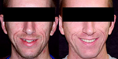 Invisalign - Invisalign