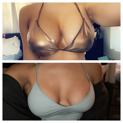 Breast Augmentation 600cc / 550cc Drop and Fluff Progress