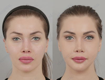 18-24 year old woman treated with V Line Surgery - No tie double jaw surgery + V line surgery + HighL Cheekbone Reduction