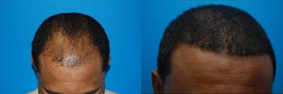 Hair Transplant 2700 Grafts. - 
	This is a 47 year old African American male who presented with Androgenic Alopecia which was unresponsive to medical therapy. We had an extensive preoperative discussion about the progressive nature of his hair loss and together we formulated a design. He underwent a follicular unit transplant and we harvested 2700 grafts from a 30 cm donor strip which was closed primarily. Because of the curly nature of his hair we carefully dissected 800 of the smallest grafts and utilized them within the anterior hairline. The remaining 1900 grafts were gently inserted, recreating a natural hairline.
