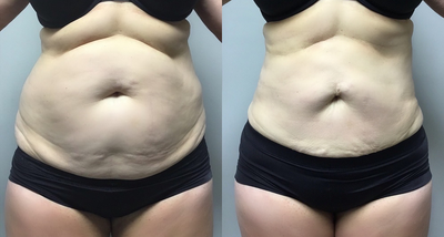 35-60 year old woman treated with Smart Lipo - 35-60 year old female treated with Smart Lipo of Abdomen and Flanks