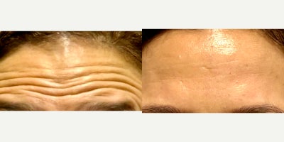 25-34 year old woman treated with Botox - 22 units of Botox to correct horizontal forehead lines