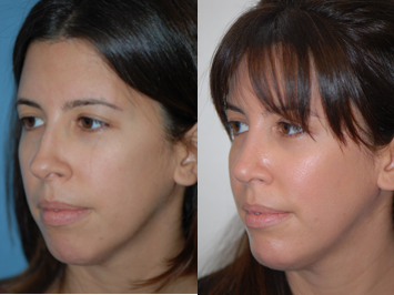 Rhinoplasty - Rhinoplasty