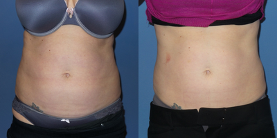 38 year old female treated with SculpSure to her abdomen and flanks. - 38 y/o female who was treated with SculpSure to her abdomen and flanks.  She is shown 6 weeks after treatment.