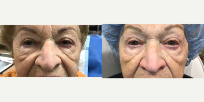 75 and up year old woman treated with Laser Treatment - 84 year old woman after two picosure focus with Vampire Facial