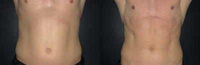 25-34 year old man treated with CoolTone - 30 year old man treated his abdomen with 6 CoolTone sessions