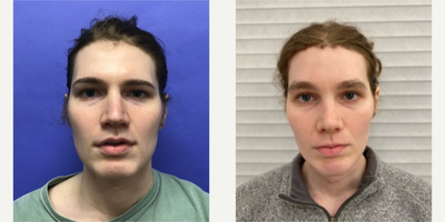 Patient treated with Facial Feminization Surgery, Transgender Facial Feminization Surgery - 25 to 34 year-old female patient is 1 month post-op from Facial Feminization surgery. Her procedures included: Forehead Lift, Hairline Lowering, Supra Orbital Bone Reduction and Contouring, Septorhinoplasty with Cartilage Grafts and Weirs, Chin Reduction and Contour, Soft Tissue to Nasolabial Folds, Intranasal Lip Lift, Thyroid Cartilage Shave, and Voice Feminization.