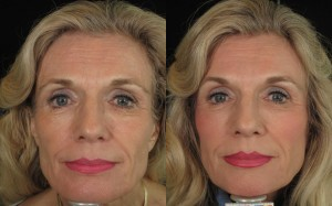 Artefill Dermal Filler  - Artefill, Dermal Filler, Dr. Skellchock