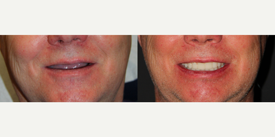 All-on-4 Dental Implants - All-on-4 Dental Implants